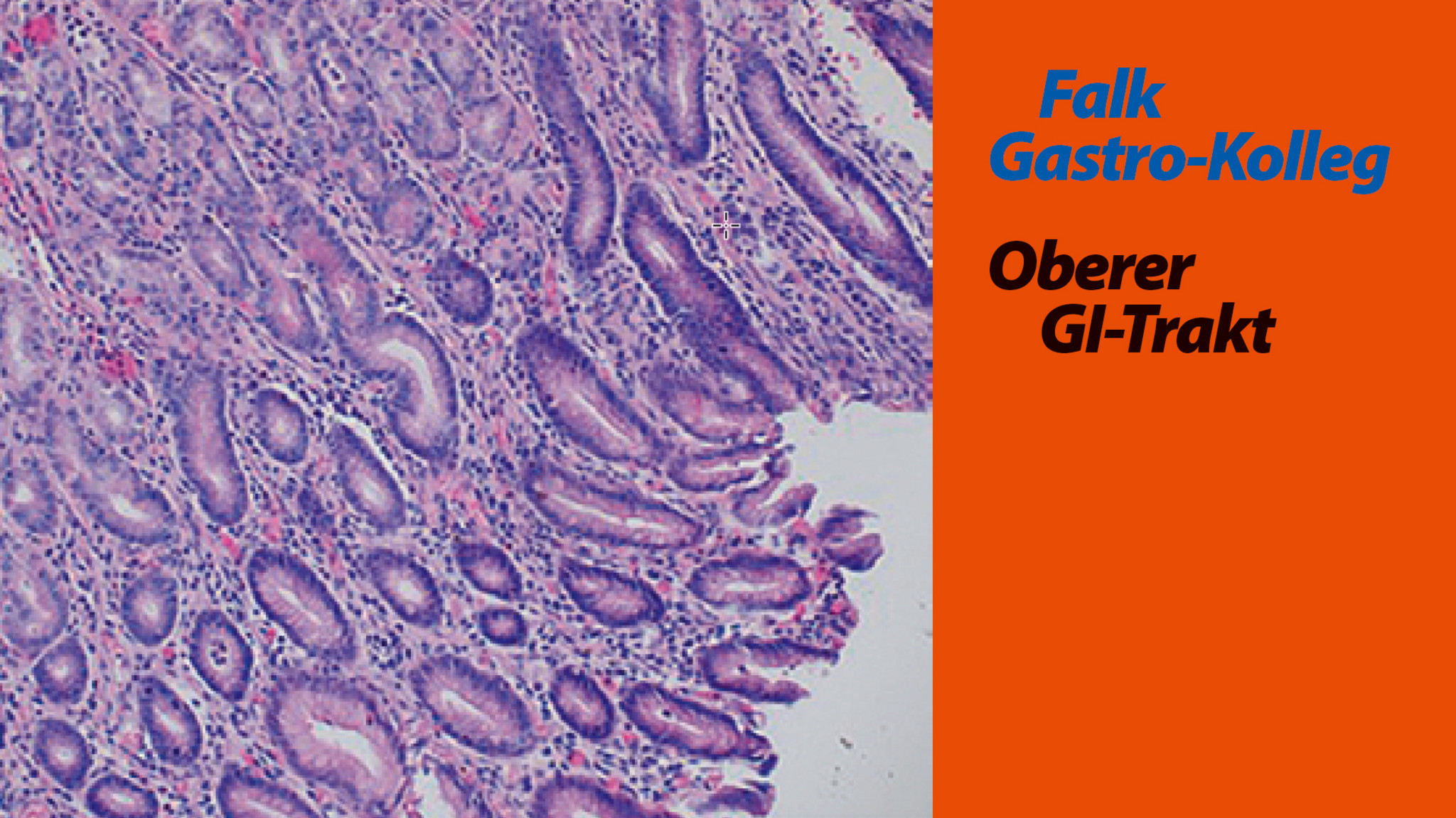 FGK_1_21_Allescher-Gastritis